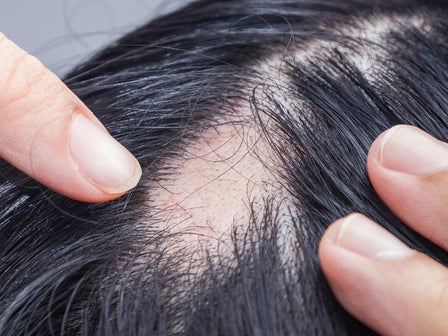 Huomasit kaljun kohdan päässäsi. Mitä nyt?