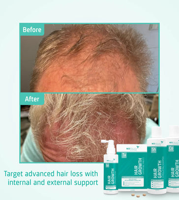 Neofollics Shampoo + Conditioner + Serum + Tablets Treatment for advanced male hereditary hair loss - Hairgivers