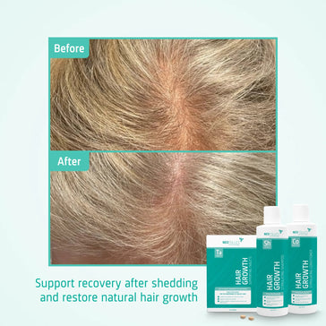Neofollics Shampoo + Balsamo + Compresse Treatment for moderate female hereditary hair loss - Hairgivers