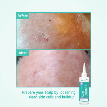 Suero peeling Neofollics para el cuero cabelludo Neofollics scalp peeling serum - Hairgivers