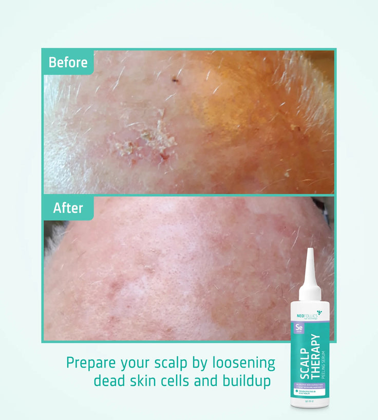 Suero peeling Neofollics para el cuero cabelludo