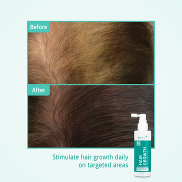 4x Neofollics-lotion + gratis hovedbundsrulle 4x Neofollics lotion + free scalp roller - Hairgivers