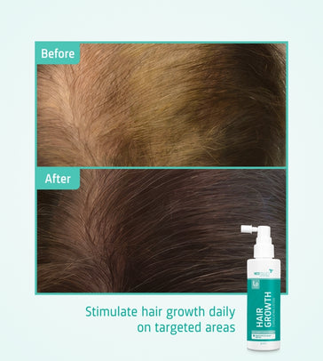 4x Neofollics lotion + free scalp roller 4x Neofollics lotion + free scalp roller - Hairgivers
