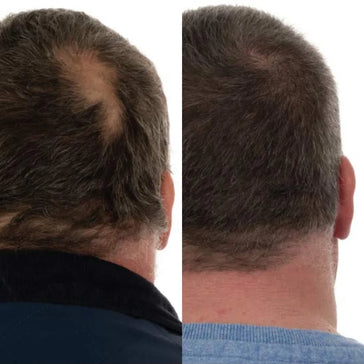 Foligain hårväxtbehandling (män) Foligain hair growth treatment (men) - Hair Growth Specialist