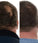 Foligain hair growth treatment (men) - Hairgivers