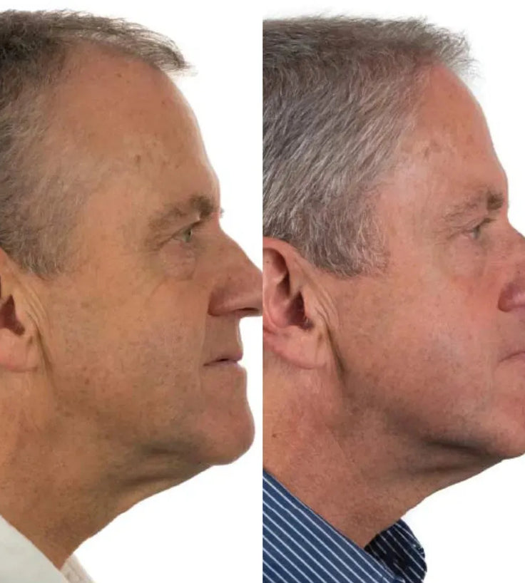 Foligain hair growth treatment (men) - Hairgivers