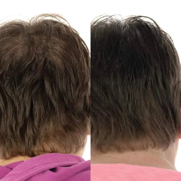 Foligain traitement pour la croissance des cheveux (femmes) Foligain hair growth treatment (women) - Hairgivers