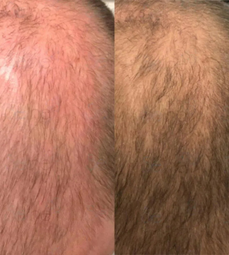 Panthrix hair growth serum (Redensyl) - Hairgivers