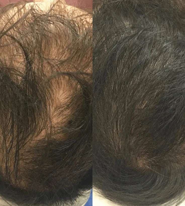 Revita hair growth shampoo + conditioner (925 ml) - Hairgivers