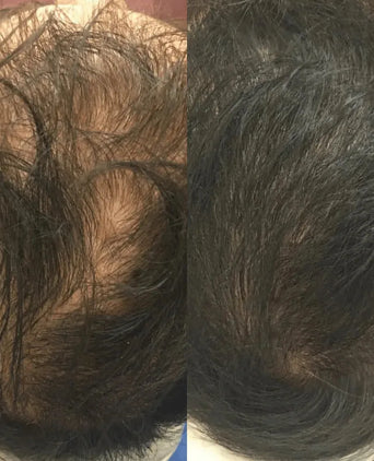 Revita comprimidos para o crescimento do cabelo (1 mês) Revita tablets for hair growth (1 month) - Hairgivers