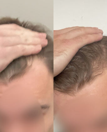 Scandinavian Biolabs Bio-Pilixin Hairline Booster recambio (paquete de 1) Scandinavian Biolabs Bio-Pilixin Hairline Booster recambio (paquete de 1)