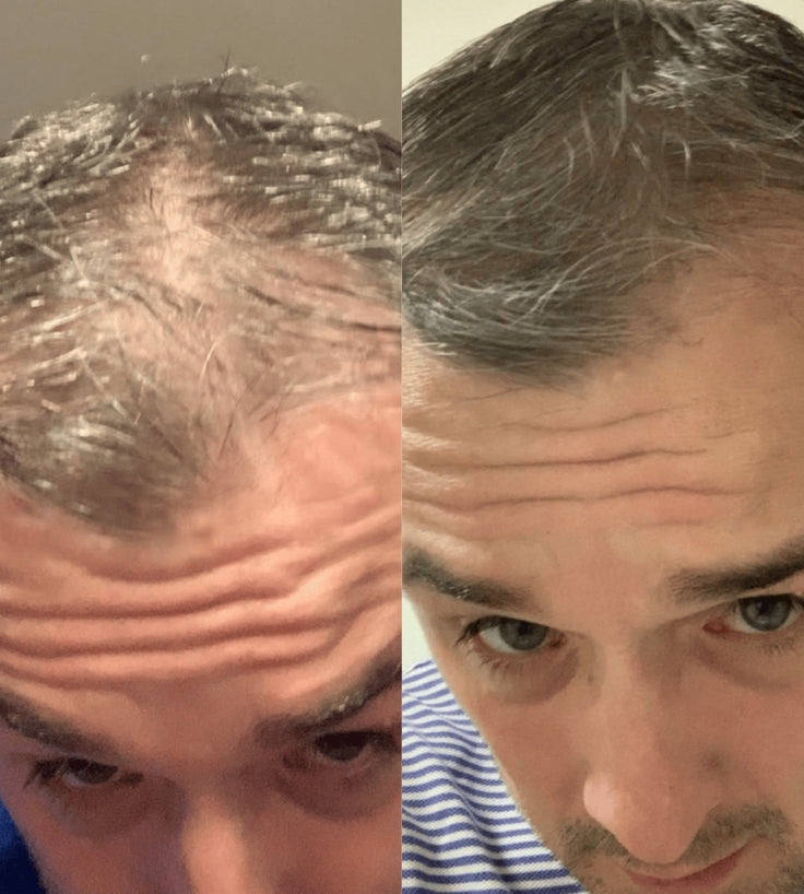 Scandinavian Biolabs Bio-Pilixin Hairline Booster