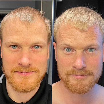 Scandinavian Biolabs hårvekstbehandling (menn) Scandinavian Biolabs hair growth treatment (men) - Hair Growth Specialist