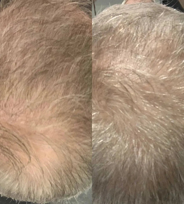 Scandinavian Biolabs hair growth treatment (men) - Hairgivers