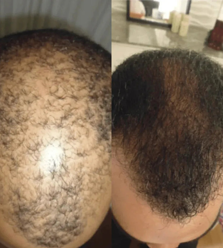 Spectral DNC-N (Nanoxidil) lotion - Hairgivers