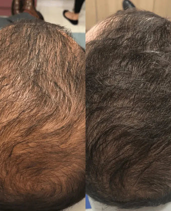 Spectral DNC-N (Nanoxidil) lotion Spectral DNC-N (Nanoxidil) lotion