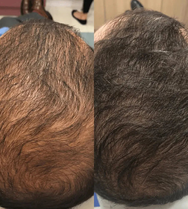 Spectral DNC-N (Nanoxidil) lotion - Hairgivers