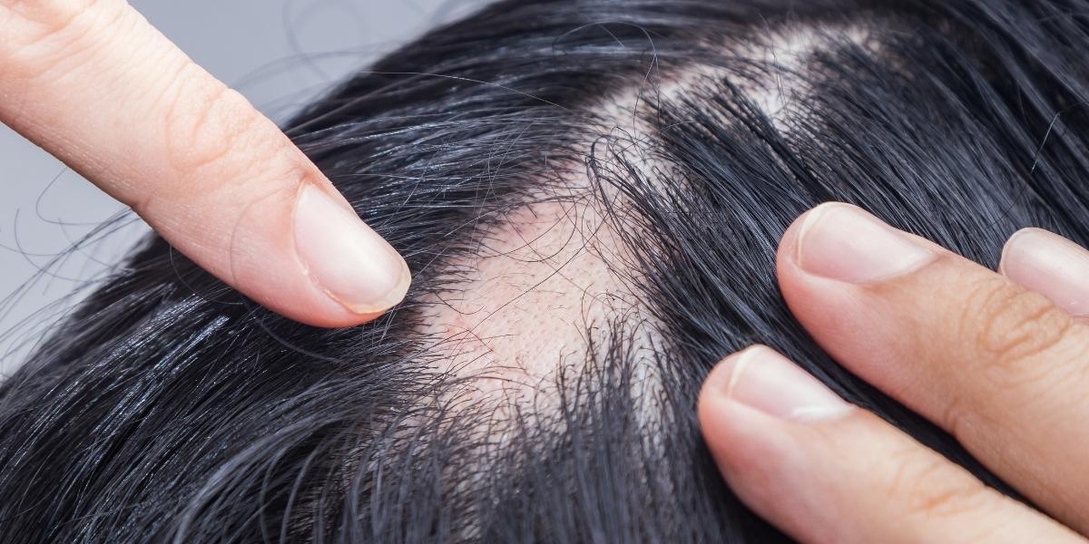 Te has descubierto una calva en la cabeza. ¿Y ahora qué?