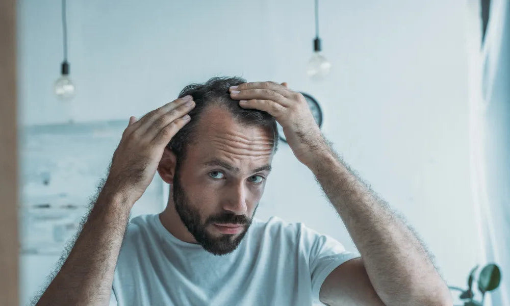 A escala de Norwood: Um guia para a calvície de padrão masculino