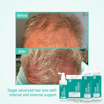 Treatment for advanced male hereditary hair loss - Hairgivers