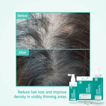 Treatment for moderate male hereditary hair loss - Hairgivers