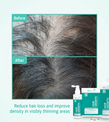 Neofollics Sjampo + Serum + Tabletter Treatment for moderate male hereditary hair loss - Hairgivers