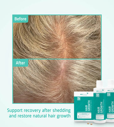 Treatment for moderate female hereditary hair loss - Hairgivers