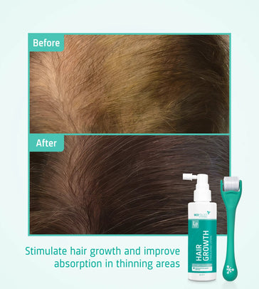 Neofollics Lotion + Scalp Roller Neofollics hair growth kit - Hairgivers