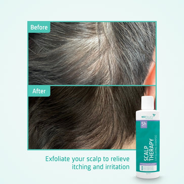 Neofollics exfoliating shampoo - Hairgivers