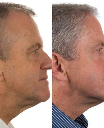 Foligain hair growth treatment (men) - Hair Growth Specialist