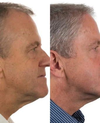 Foligain hair growth treatment (men) - Hairgivers