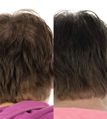Foligain hair growth treatment (women) - Hair Growth Specialist