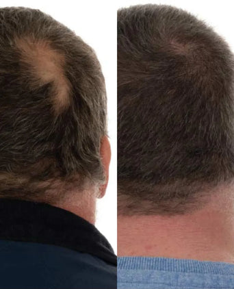 Foligain hair loss shampoo + conditioner men (236 ml) - Hair Growth Specialist