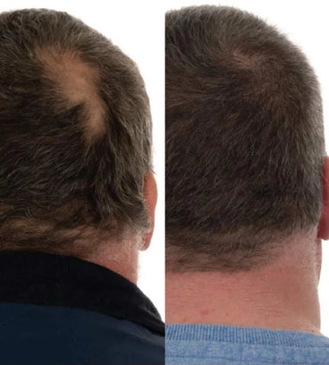 Foligain hair loss shampoo + conditioner men (236 ml) - Hair Growth Specialist