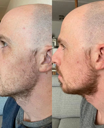 Neofollics beard growth kit - Hair Growth Specialist