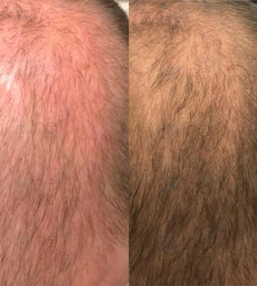 Panthrix hair growth serum (Redensyl) - Hair Growth Specialist