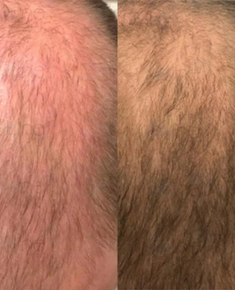 Panthrix hair growth serum (Redensyl) - Hairgivers