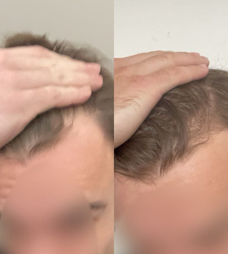 Scandinavian Biolabs Bio-Pilixin Hairline Booster refill (3-pk)