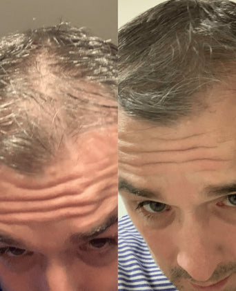 Ricarica Scandinavian Biolabs Bio-Pilixin Hairline Booster (confezione da 1)