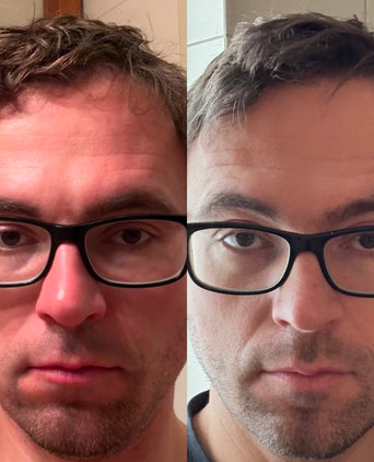 Ricarica Scandinavian Biolabs Bio-Pilixin Hairline Booster (confezione da 1)