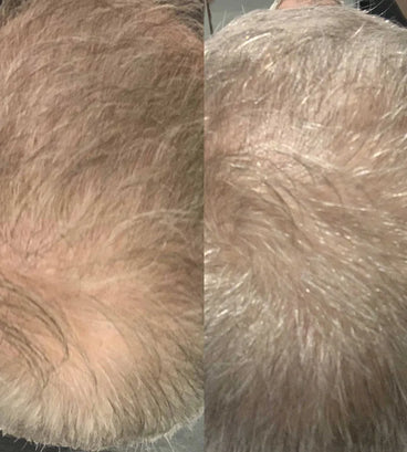 Scandinavian Biolabs hair growth treatment (men) - Hair Growth Specialist