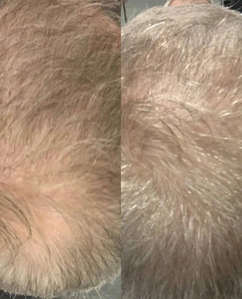 Scandinavian Biolabs hair growth treatment (men) - Hairgivers
