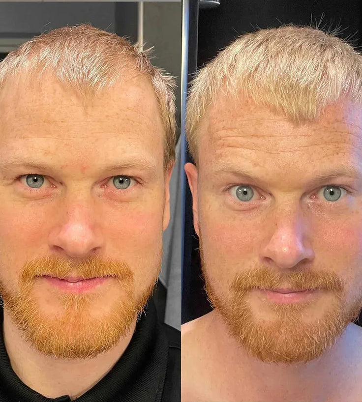 Scandinavian Biolabs hair growth treatment (men) - Hairgivers