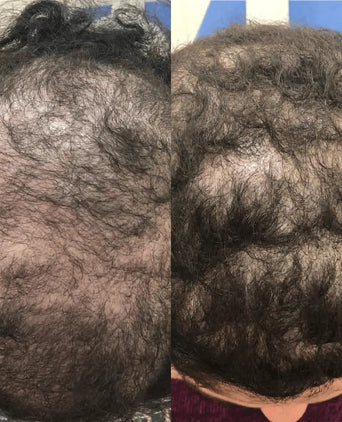 Spectral.CSF (Adenosine) lotion - Hair Growth Specialist