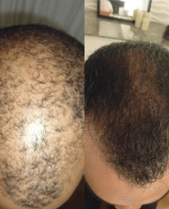 Spectral DNC-N (Nanoxidil) lotion - Hair Growth Specialist