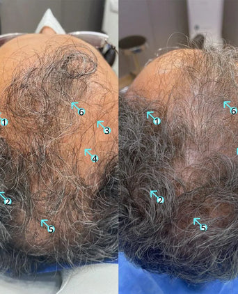 Spectral.DNC-S (Melanex) lotion - Hair Growth Specialist