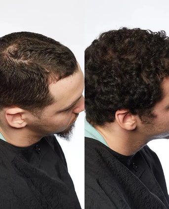 Theradome LH80 PRO laser helmet - Hairgivers