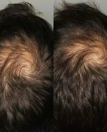 Viviscal hair growth tablets for men (3 months) - Hair Growth Specialist