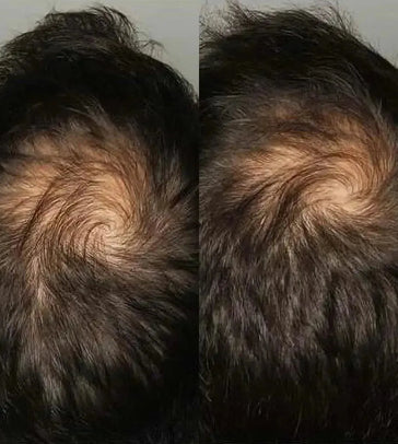 Compresse Viviscal per la crescita dei capelli per uomo (3 mesi) Viviscal hair growth tablets for men (3 months) - Hairgivers